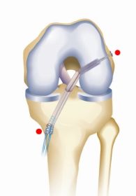 ACL-ARTHREX-SCHEMA.jpg